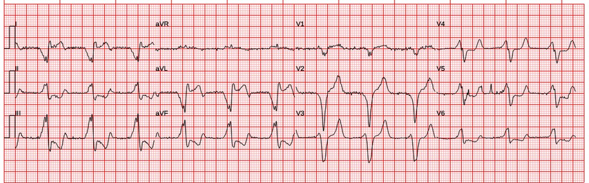 Stephen W. Smith (@smithecgblog) on Twitter photo A sick elderly patient with nonspecific symptoms
hqmeded-ecg.blogspot.com/2025/05/a-sick…
<a href="/PendellM/">Pendell Meyers</a> A sick elderly patient with nonspecific symptoms
hqmeded-ecg.blogspot.com/2025/05/a-sick…
<a href="/PendellM/">Pendell Meyers</a>