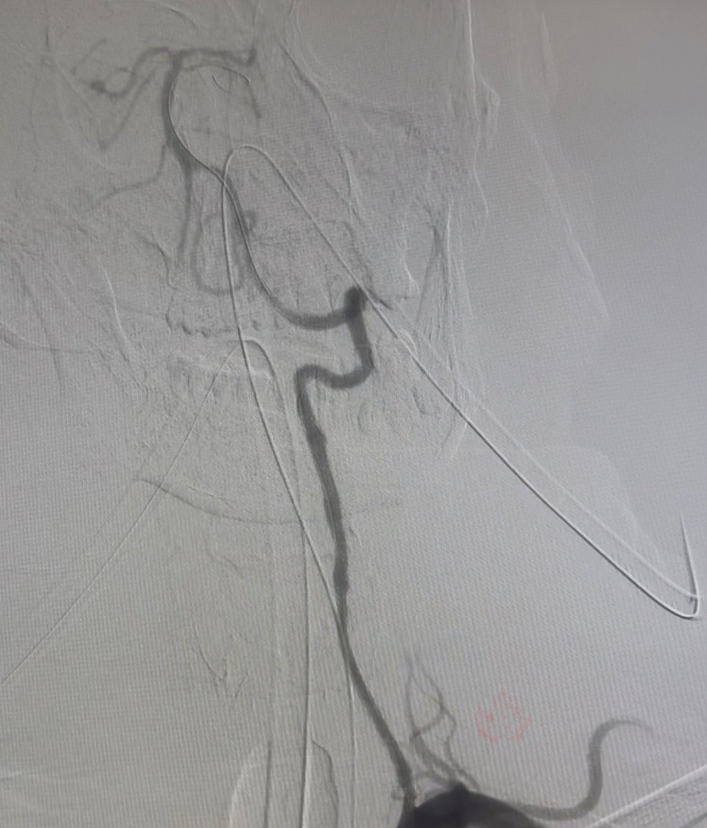 AlAli Meshari , MD د.مشاري العلي (@mesharyalali) on Twitter photo On maximum medical therapy for 2 years
Although,
Last week developed multiple posterior fossa infarction.(as patient was dependent on diseased RT) 
Chose LT which was near occlusion of V1/V2 total occlusion of V4, successful stenting using multiple Coronary DES On maximum medical therapy for 2 years
Although,
Last week developed multiple posterior fossa infarction.(as patient was dependent on diseased RT) 
Chose LT which was near occlusion of V1/V2 total occlusion of V4, successful stenting using multiple Coronary DES