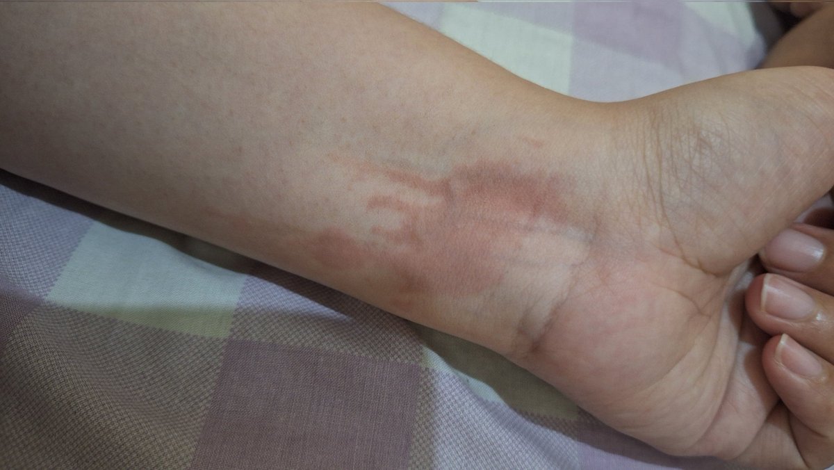 Menyambut bertambahnya usia dengan minyak panas, hikmahnya kudu lebih ati-ati. 
Apa iya kudu diem-diam aja kalo mau ultah biar gak kejadian macem begini.