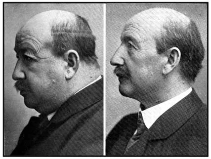 Thyroid hormone (T3): The cure for obesity?

Balancing thyroid hormone (T3) lowers fat and swelling of your face

Before and after increasing thyroid hormone:
