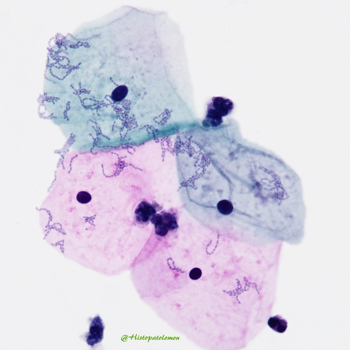Histopatolomon's tweet photo. In this cytology of voided urine we can compare the size of eukaryotic and prokaryotic cells, the bacteria that form chains. #cytology #Gupath #cytopath #pathlogy #urine #cytopathology @Danielaasd https://t.co/2nEi2EP6mQ