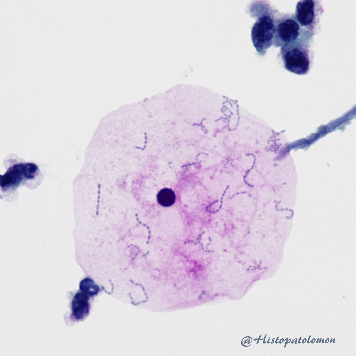 Histopatolomon's tweet photo. In this cytology of voided urine we can compare the size of eukaryotic and prokaryotic cells, the bacteria that form chains. #cytology #Gupath #cytopath #pathlogy #urine #cytopathology @Danielaasd https://t.co/2nEi2EP6mQ
