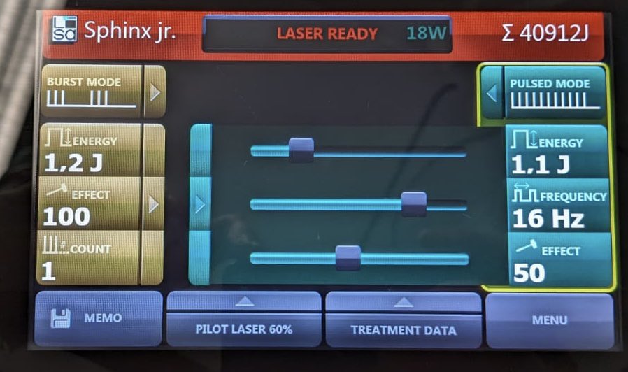 Mario Sofer (@mario_sofer) on Twitter photo When the patient is already under general anesthesia and your high-power machine brake down: Very low power HoLEP with 27 W for 110 cc prostate is feasible <a href="/scoffonecesare/">scoffone cesare</a> <a href="/fgomsan/">Fernando GomezSancha</a> When the patient is already under general anesthesia and your high-power machine brake down: Very low power HoLEP with 27 W for 110 cc prostate is feasible <a href="/scoffonecesare/">scoffone cesare</a> <a href="/fgomsan/">Fernando GomezSancha</a>