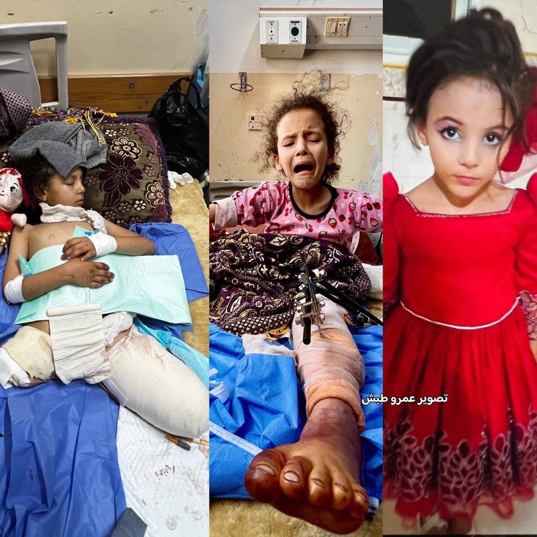 Sila Madi was an israeli target: they bombed her hoping she’d die; she survived but without her leg, and in the end they were both amputated