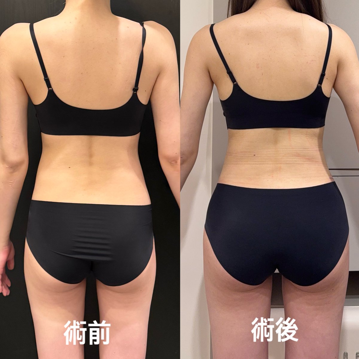 _kittychan22's tweet photo. レアートさんで腹部、副乳(再)、骨盤ラインの脂肪移植をして頂きました✨

吸引量:2100cc、骨盤の移植:200ccずつ

元々なかったくびれができて嬉しいです☺️
骨盤ラインは凹みが解消され腰回りのラインが綺麗になりとても満足しています🤍

#レアート #ソ院長 #脂肪吸引 #脂肪移植 https://t.co/sbH33PirwH