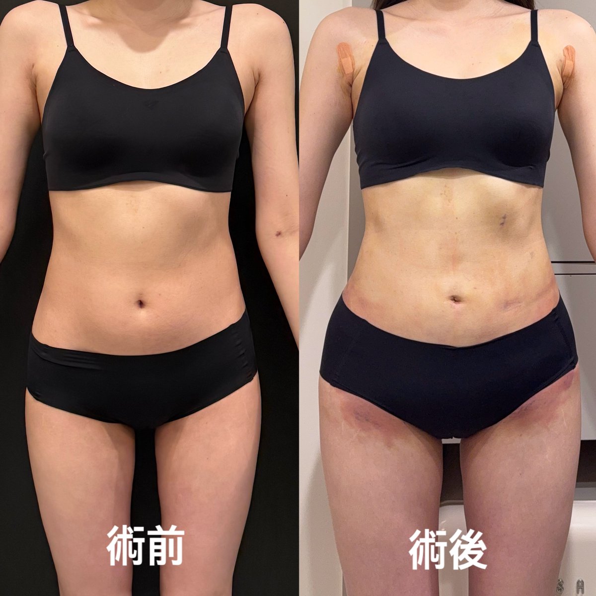 _kittychan22's tweet photo. レアートさんで腹部、副乳(再)、骨盤ラインの脂肪移植をして頂きました✨

吸引量:2100cc、骨盤の移植:200ccずつ

元々なかったくびれができて嬉しいです☺️
骨盤ラインは凹みが解消され腰回りのラインが綺麗になりとても満足しています🤍

#レアート #ソ院長 #脂肪吸引 #脂肪移植 https://t.co/sbH33PirwH