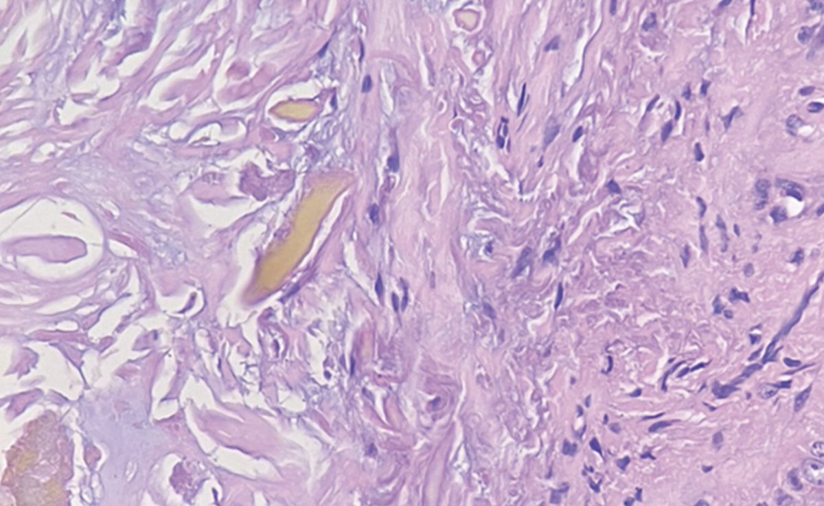 Christine J. Ko, MD (@christinejkomd) on Twitter photo diagnosis? #dermpath #dermatology #pathology jamanetwork.com/journals/jamad… <a href="/JAMADerm/">JAMA Dermatology</a> diagnosis? #dermpath #dermatology #pathology jamanetwork.com/journals/jamad… <a href="/JAMADerm/">JAMA Dermatology</a>