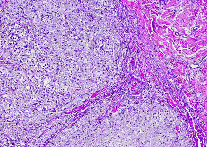mydocwire's tweet image. #ASCO25 🚀  
🧬 New research reveals how #organoids provide key insight into #melanoma drug resistance.  
🧪 Could this be a turning point in personalized cancer therapies?  
🔗 buff.ly/vkOLnvQ  
#CancerResearch #Melanoma #Organoids #DrugResistance #Oncology