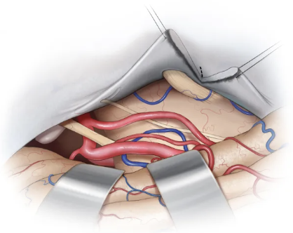 If the tentorial incision is extended to the most lateral aspect of the  Meckel’s cave, the trigeminal nerve and the origin of the anterior  inferior cerebellar artery (AICA) can be visualized. 

Learn more here: zurl.co/YQyAG 

#Neurosurgery #CranialBaseSurgery