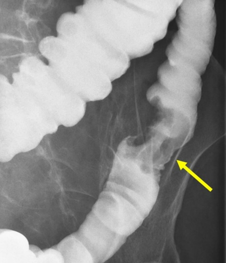 gastroudla's tweet photo. El enema baritado de doble contraste en cáncer colorrectal es una alternativa a la colonoscopia, con una sensibilidad de 85 a 97%. 
Imágenes que visualizan la estenosis de la luz mostrando el signo de “corazón de manzana” (semeja a una manzana mordida) ¿Qué opinas? #imagengastro https://t.co/pWlsvikqVn