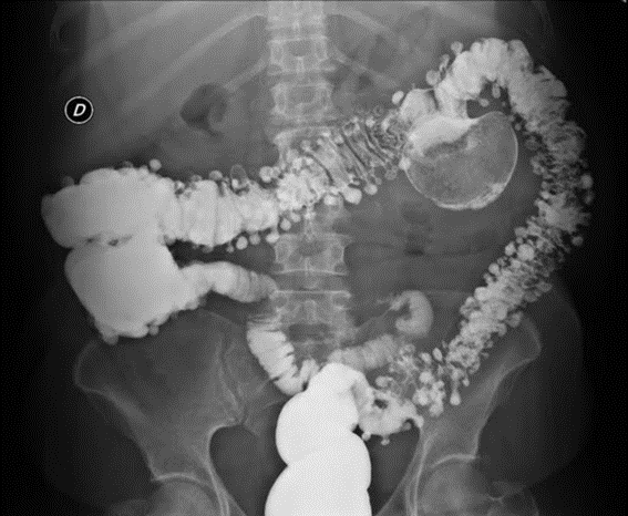 gastroudla's tweet photo. El colon por enema puede detectar divertículos hasta en el 71 a 93% de casos. Aquí observamos múltiples divertículos distribuidos en todo el colon y además un divertículo colónico gigante localizado en el tercio distal del colon transverso. Impresionante ¿Verdad? #imagengastro https://t.co/rzhAgrYjEU