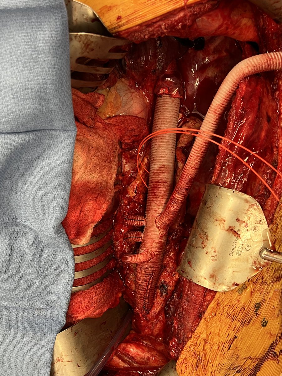 Our setup for TAAA with VA ECMO.  14mm intercostal graft for arterial cannulation, R femoral vein cannulation, Fogarty catheters in the intercostals to be preserved.  Next step - off ECMO, divide 14 mm graft and sew it to intercostals.  Total transfusion 1 unit PRBC.  #aortaEd