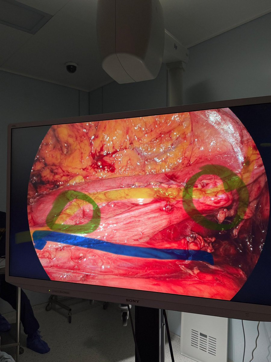 Gonadal vein with teratoma.Include gonadal vessels during RPLND for testicular cancer! #testicularcancer <a href="/TestesCancer/">Testicular Cancer</a> #uroncology