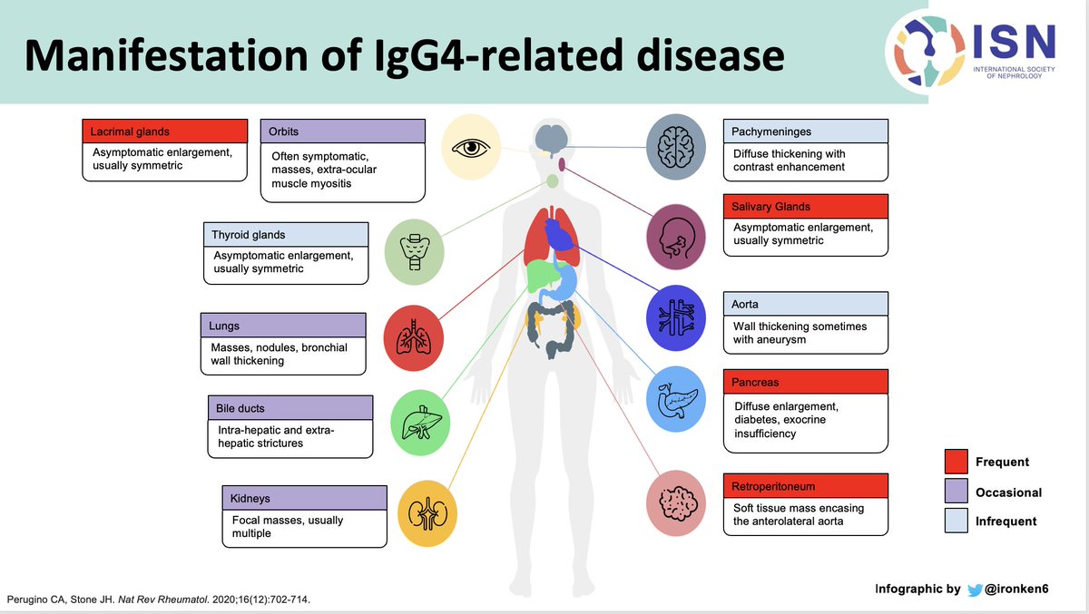 ISN Education (@isneducation) on Twitter photo 18/n <a href="/ISNkidneycare/">Int Society of Nephrology</a> <a href="/myadla/">manjusha yadla</a> <a href="/Ren_Familia/">AS</a> <a href="/Dilushiwijay/">Dilushi Wijayaratne</a> #ECNeph
What are the clinical manifestations of IgG4 RD?
Check this excellent infographic by <a href="/Ironken6/">Fong Voon Ken</a> 18/n <a href="/ISNkidneycare/">Int Society of Nephrology</a> <a href="/myadla/">manjusha yadla</a> <a href="/Ren_Familia/">AS</a> <a href="/Dilushiwijay/">Dilushi Wijayaratne</a> #ECNeph
What are the clinical manifestations of IgG4 RD?
Check this excellent infographic by <a href="/Ironken6/">Fong Voon Ken</a>