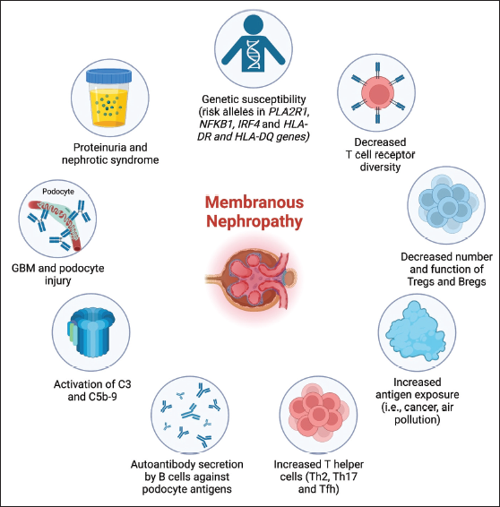 Anagha (@anaghashreyas) on Twitter photo 🔬🦠Pathophysiology of Membanous Nephropathy
#MedTwitter #NephTwitter #Glomcon #Glomerulardiseasae #Nephroticsyndrome
Reference : indianjnephrol.org/an-updated-rev…
<a href="/AnandhUrmila/">Urmila Anandh</a> <a href="/edgarvlermamd/">Edgar V. Lerma 🇵🇭</a> <a href="/isn_india/">Indian Society of Nephrology</a> <a href="/OrhanEfe_/">Orhan Efe</a> <a href="/NWiegley/">Nasim Wiegley, MD, FASN</a> <a href="/indianjnephrol/">Indian Journal of Nephrology</a> 🔬🦠Pathophysiology of Membanous Nephropathy
#MedTwitter #NephTwitter #Glomcon #Glomerulardiseasae #Nephroticsyndrome
Reference : indianjnephrol.org/an-updated-rev…
<a href="/AnandhUrmila/">Urmila Anandh</a> <a href="/edgarvlermamd/">Edgar V. Lerma 🇵🇭</a> <a href="/isn_india/">Indian Society of Nephrology</a> <a href="/OrhanEfe_/">Orhan Efe</a> <a href="/NWiegley/">Nasim Wiegley, MD, FASN</a> <a href="/indianjnephrol/">Indian Journal of Nephrology</a>