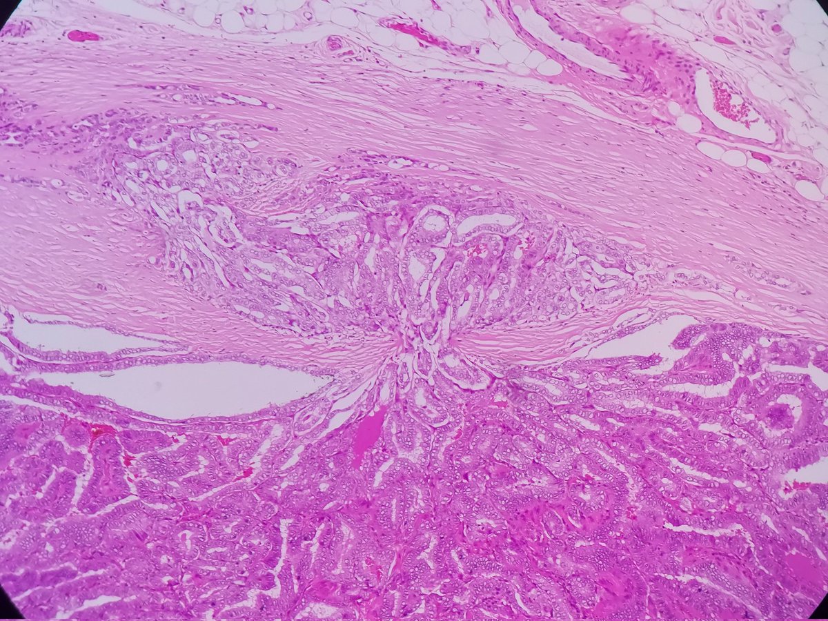 padmapathology1's tweet image. Capsular invasion
-Mushrooming 
Thyroid carcinoma
#PathTwitter 
#pathresidents