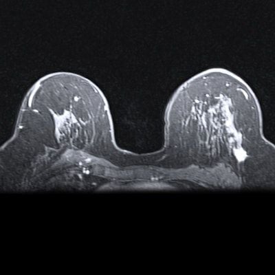AuntMinnie.com (@auntminnie) on Twitter photo A team led by Fiona Gilbert, MD, from the University of Cambridge in England found that both modalities detected three times as many invasive cancers compared with automated breast ultrasound (ABUS) #radiology #MRI #CEM <a href="/Cambridge_Uni/">Cambridge University</a> <a href="/fjg28_fiona/">Fiona Gilbert</a> buff.ly/A06rtRE A team led by Fiona Gilbert, MD, from the University of Cambridge in England found that both modalities detected three times as many invasive cancers compared with automated breast ultrasound (ABUS) #radiology #MRI #CEM <a href="/Cambridge_Uni/">Cambridge University</a> <a href="/fjg28_fiona/">Fiona Gilbert</a> buff.ly/A06rtRE