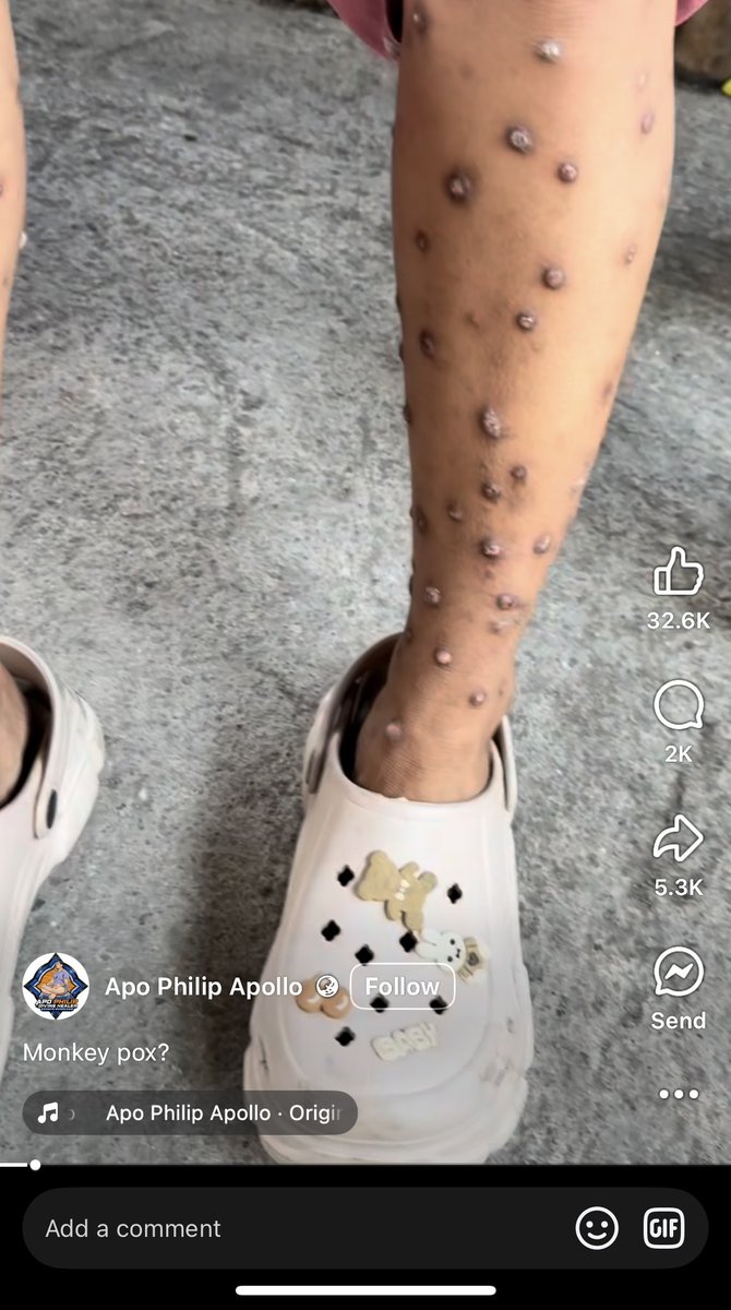 Thats prurigo nodularis. Not mpox

Also, that needs steroid injections or phototherapy. Not dasal dasal