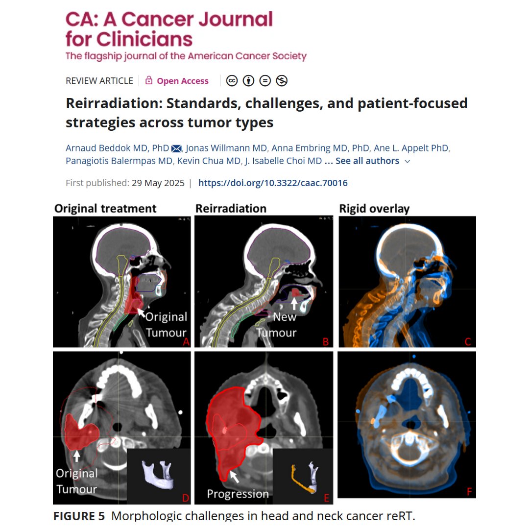 CA: A Cancer Journal for Clinicians (@cacancerjournal) on Twitter photo Reirradiation (reRT) is reshaping cancer care—offering hope for recurrent tumors w/ advanced precision techniques like IMRT & SBRT. Multidisciplinary care, imaging, and innovation are key.
New #OpenAccess review by Andratschke et al:
acsjournals.onlinelibrary.wiley.com/doi/full/10.33…
<a href="/OncoAlert/">OncoAlert</a> #RadOnc Reirradiation (reRT) is reshaping cancer care—offering hope for recurrent tumors w/ advanced precision techniques like IMRT & SBRT. Multidisciplinary care, imaging, and innovation are key.
New #OpenAccess review by Andratschke et al:
acsjournals.onlinelibrary.wiley.com/doi/full/10.33…
<a href="/OncoAlert/">OncoAlert</a> #RadOnc