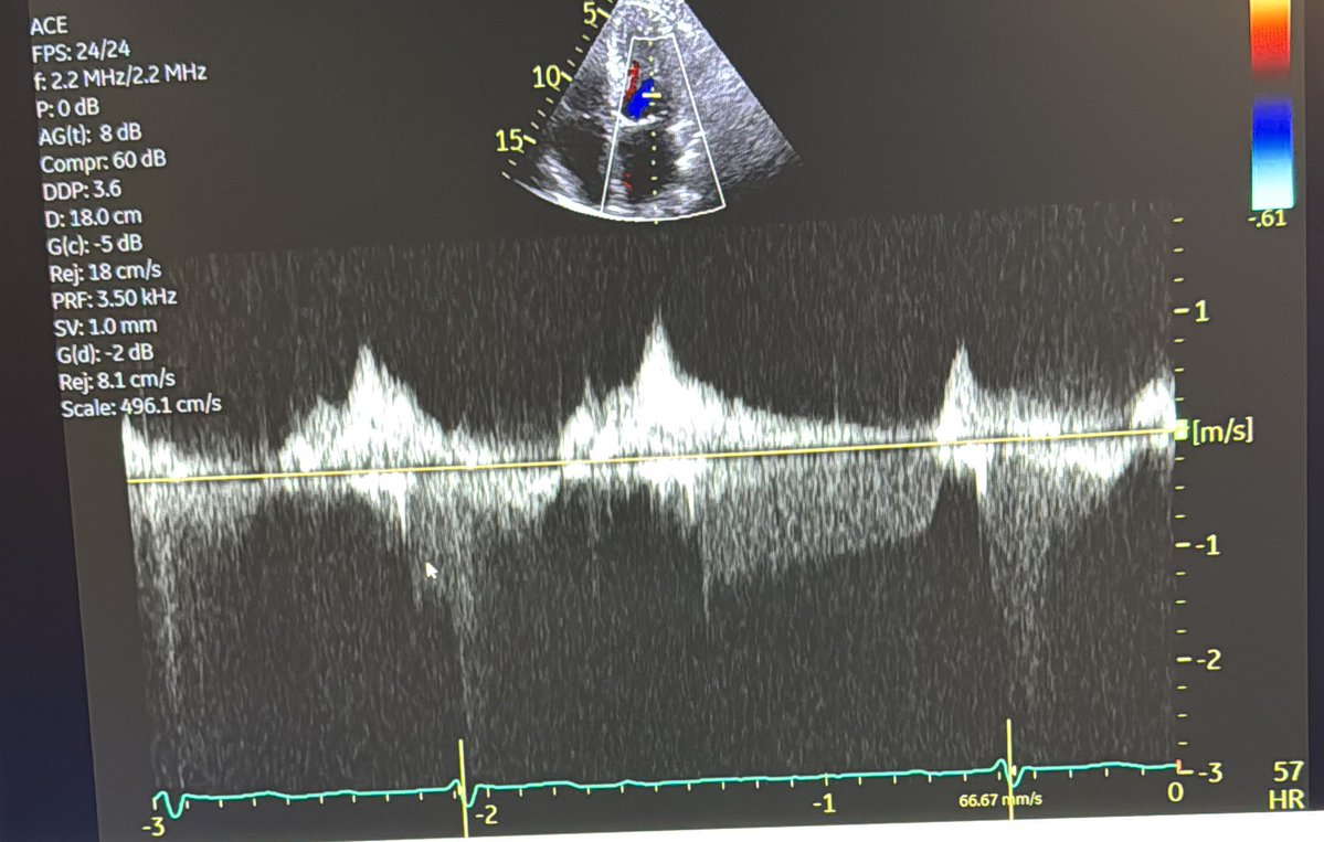 Sudarshan Balla (@sudarshanballa) on Twitter photo Intriguing CW Doppler across Mitral valve. I have a guess but had to scratch my head for a minute. Doppler never lies - flow always needs explained. What could explain the second beat - flow below Baseline. #echofirst <a href="/WvuCvFellows/">WVU CV fellows</a> <a href="/BritoCardio/">Daniel Brito MD, FACC</a> <a href="/argulian/">Edgar Argulian</a> <a href="/CASivaram1/">Chittur Sivaram</a> <a href="/iamritu/">Ritu Thamman MD</a> Intriguing CW Doppler across Mitral valve. I have a guess but had to scratch my head for a minute. Doppler never lies - flow always needs explained. What could explain the second beat - flow below Baseline. #echofirst <a href="/WvuCvFellows/">WVU CV fellows</a> <a href="/BritoCardio/">Daniel Brito MD, FACC</a> <a href="/argulian/">Edgar Argulian</a> <a href="/CASivaram1/">Chittur Sivaram</a> <a href="/iamritu/">Ritu Thamman MD</a>