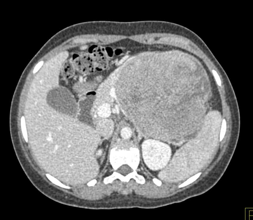 Gastric GIST Tumor: ctisus.com/teachingfiles/…
