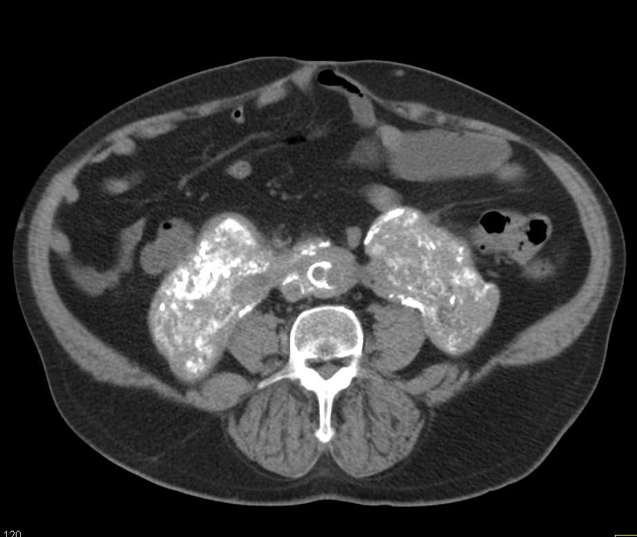 Retroperitoneal Fibrosis: ctisus.com/teachingfiles/…