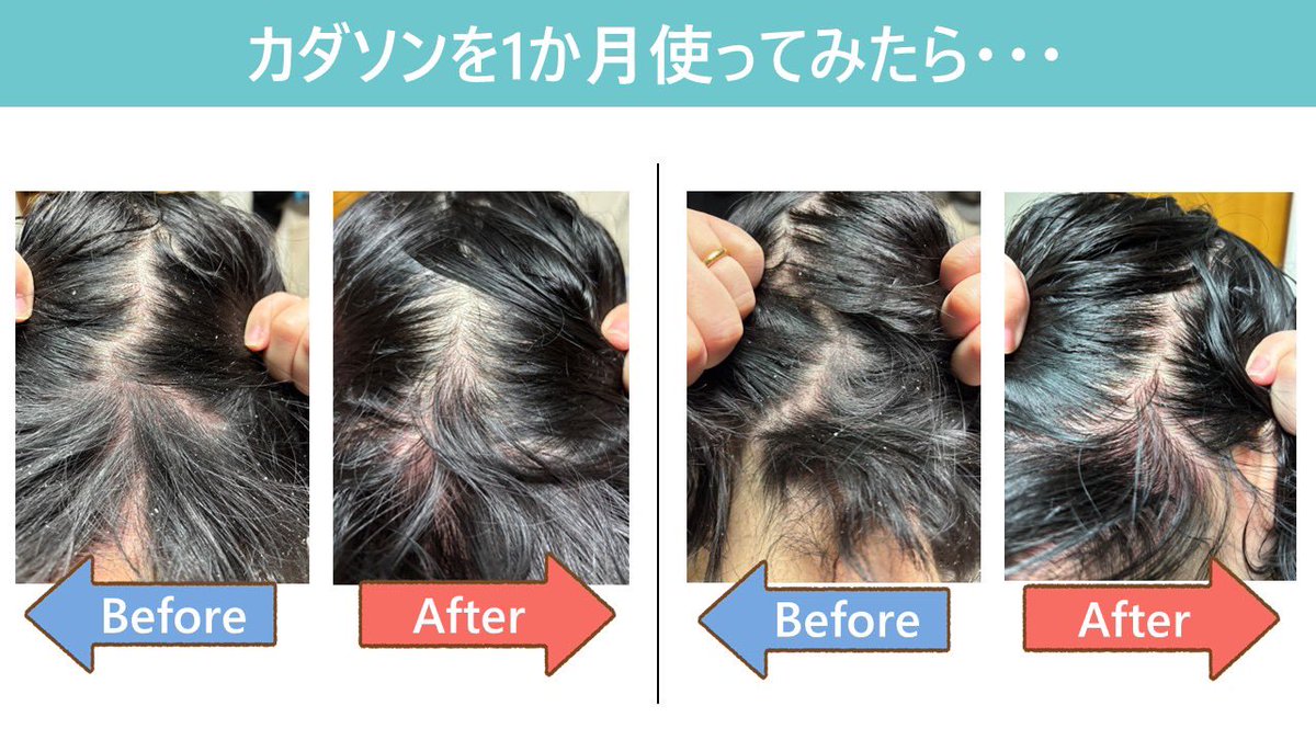 hadayowa_san's tweet photo. 最近の頭皮の落ち着きは本当にシャンプーのおかげなのか？体質が良くなったからなのか？前に使ってたシャンプーに戻して検証してみた👀
結果…かゆみ･痛み発生⚡やっぱり脂漏性皮膚炎を考えて作られたカダソンはすごい！1ヶ月で症状が緩和したもんね💡
もう浮気しません！笑

#脂漏性皮膚炎
#KADASON https://t.co/YY8bHhqjlR