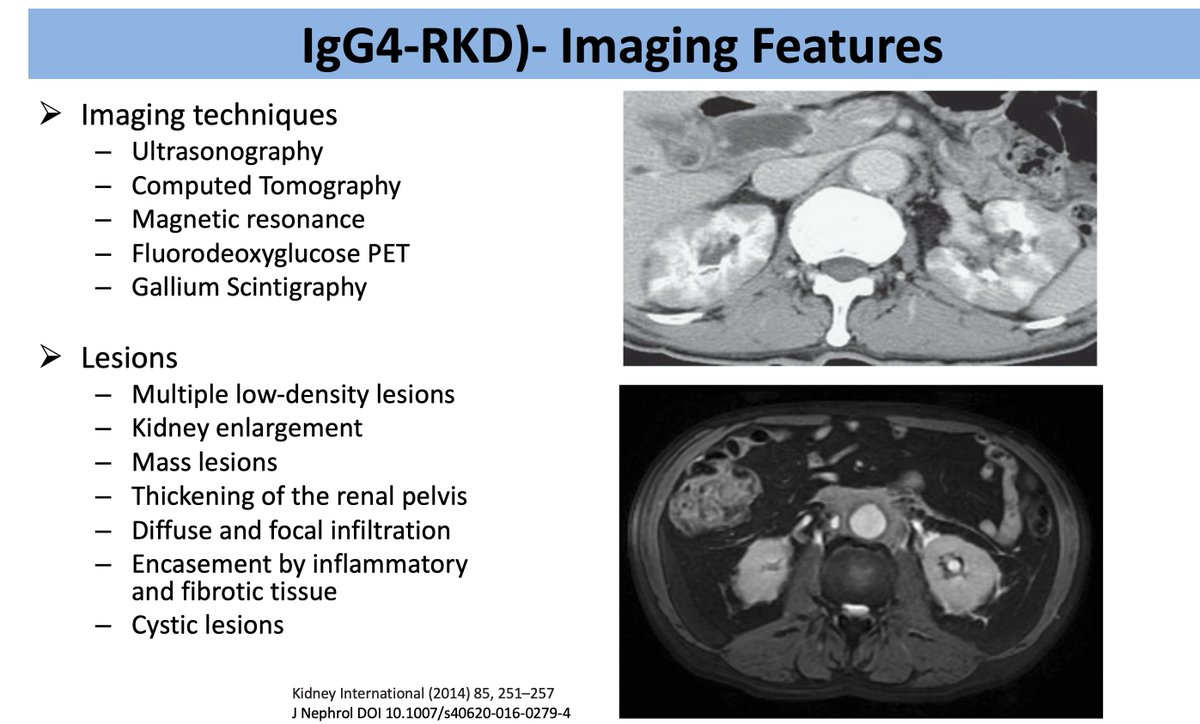 AS (@ren_familia) on Twitter photo 14/n IgG4-RKD: Imaging features
🖼️ USG/CT: Enlarged kidneys, hypodense lesions
🎯 FDG-PET/Ga Scans: Hot spots
📌 May mimic tumors or infections
🧊 Retroperitoneal fibrosis, renal pelvic thickening
#ECNeph <a href="/myadla/">manjusha yadla</a> <a href="/dra_miliflores/">Milagros Flores</a> <a href="/Dilushiwijay/">Dilushi Wijayaratne</a> <a href="/Ironken6/">Fong Voon Ken</a> <a href="/ISNkidneycare/">Int Society of Nephrology</a> 14/n IgG4-RKD: Imaging features
🖼️ USG/CT: Enlarged kidneys, hypodense lesions
🎯 FDG-PET/Ga Scans: Hot spots
📌 May mimic tumors or infections
🧊 Retroperitoneal fibrosis, renal pelvic thickening
#ECNeph <a href="/myadla/">manjusha yadla</a> <a href="/dra_miliflores/">Milagros Flores</a> <a href="/Dilushiwijay/">Dilushi Wijayaratne</a> <a href="/Ironken6/">Fong Voon Ken</a> <a href="/ISNkidneycare/">Int Society of Nephrology</a>