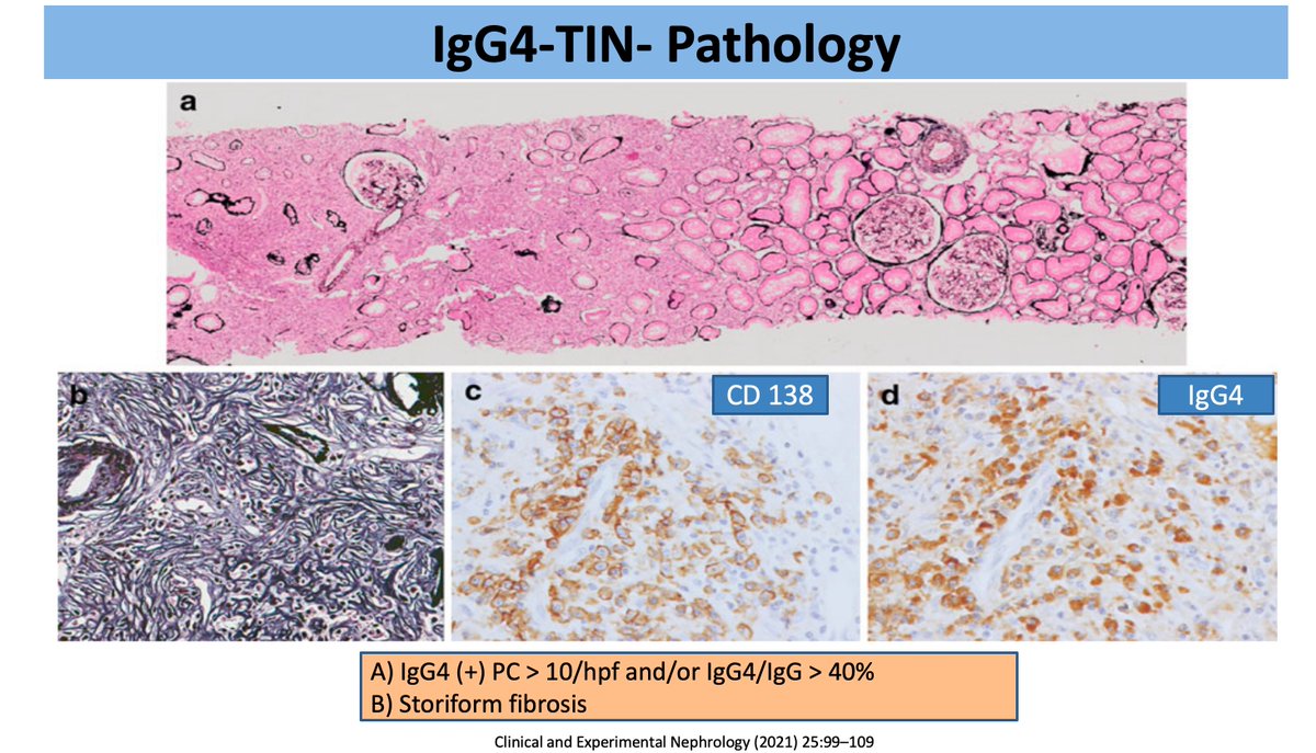 AS (@ren_familia) on Twitter photo 16/n Diagnostic criteria for IgG4-TIN 🔍
🔬 Histology: >10 IgG4+ plasma cells/hpf, TBM immune deposits
🖼️ Imaging: Enlarged kidneys, cortical nodules
🧪 Serology: Elevated serum IgG4 or total IgG
🫀 Systemic clues
#ECNeph <a href="/myadla/">manjusha yadla</a> <a href="/ISNkidneycare/">Int Society of Nephrology</a> 16/n Diagnostic criteria for IgG4-TIN 🔍
🔬 Histology: >10 IgG4+ plasma cells/hpf, TBM immune deposits
🖼️ Imaging: Enlarged kidneys, cortical nodules
🧪 Serology: Elevated serum IgG4 or total IgG
🫀 Systemic clues
#ECNeph <a href="/myadla/">manjusha yadla</a> <a href="/ISNkidneycare/">Int Society of Nephrology</a>