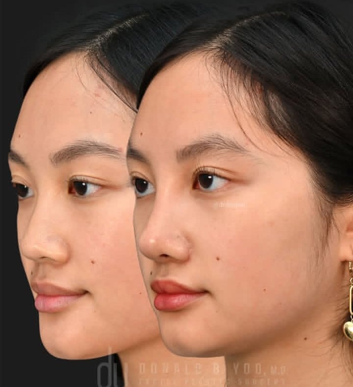 cruny14's tweet photo. Rhinoplasty + alarplasty (nostril reduction), 2 months post-op. #yoonose

This patient is healing beautifully and is on the faster side of recovery. Her alar incisions are maturing well-any residual redness is expected at this stage and will continue to fade. https://t.co/0oDVyaYSB8