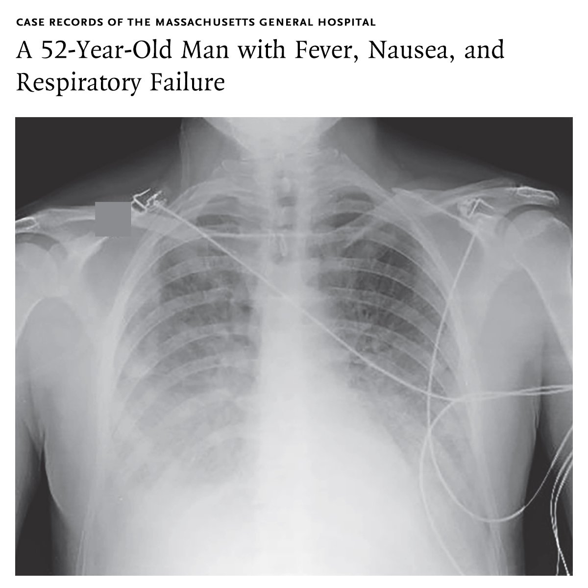 NEJM (@nejm) on Twitter photo Case Record of the Massachusetts General Hospital (<a href="/MassGeneralNews/">MassGeneral News</a>): A 52-year-old man was evaluated in a hospital in Argentina for fever and hypoxemic respiratory failure. Imaging showed pulmonary opacities, and the hematocrit was 56.9%. A diagnosis was made. Read the full case Case Record of the Massachusetts General Hospital (<a href="/MassGeneralNews/">MassGeneral News</a>): A 52-year-old man was evaluated in a hospital in Argentina for fever and hypoxemic respiratory failure. Imaging showed pulmonary opacities, and the hematocrit was 56.9%. A diagnosis was made. Read the full case