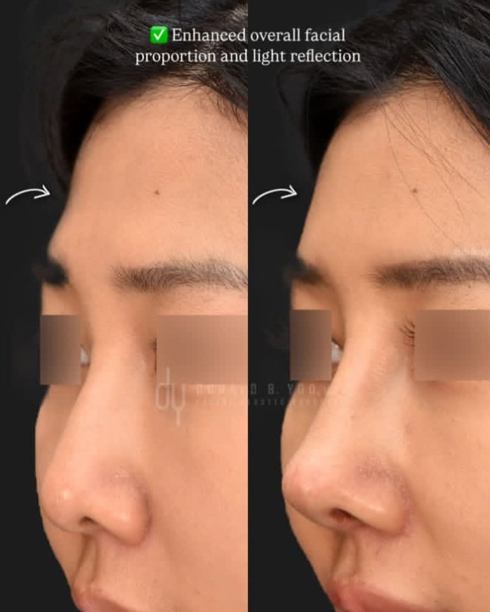 cruny14's tweet photo. Forehead volume loss is one of the most overlooked signs of facial aging. It also plays a critical role in softening facial contours and restoring natural balance.

Some patients are naturally born with a flatter forehead, while others experience volume loss over time https://t.co/g6UZdms11k