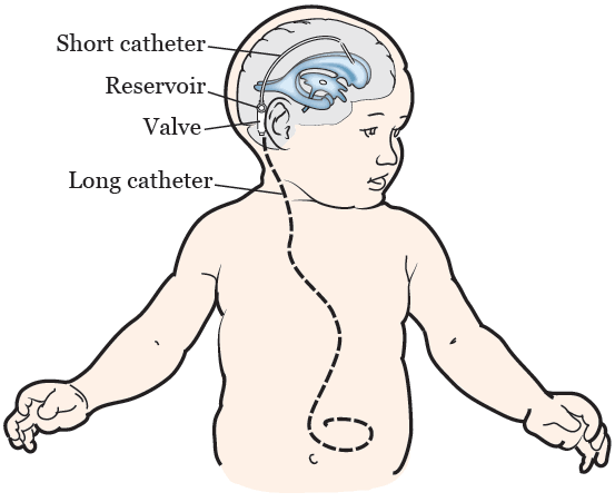 What's the procedure??
Indications and Complications??