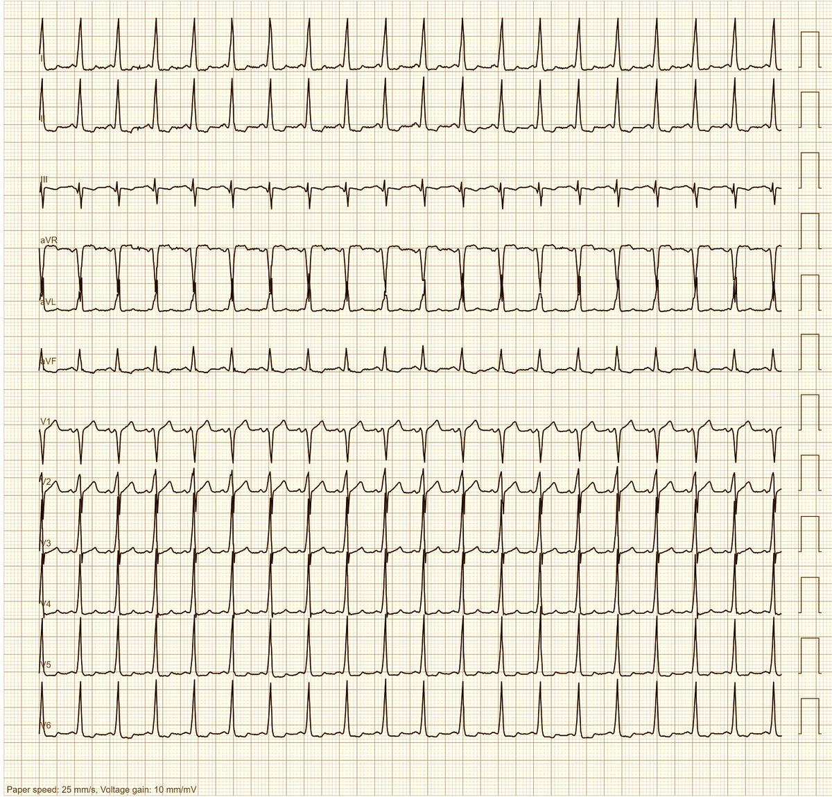 A 30-year-old man with palpitations when stressed (only slightly pronounced) and at rest (very strong). Slight palpitations at the moment when studying for an exam. What do you think?