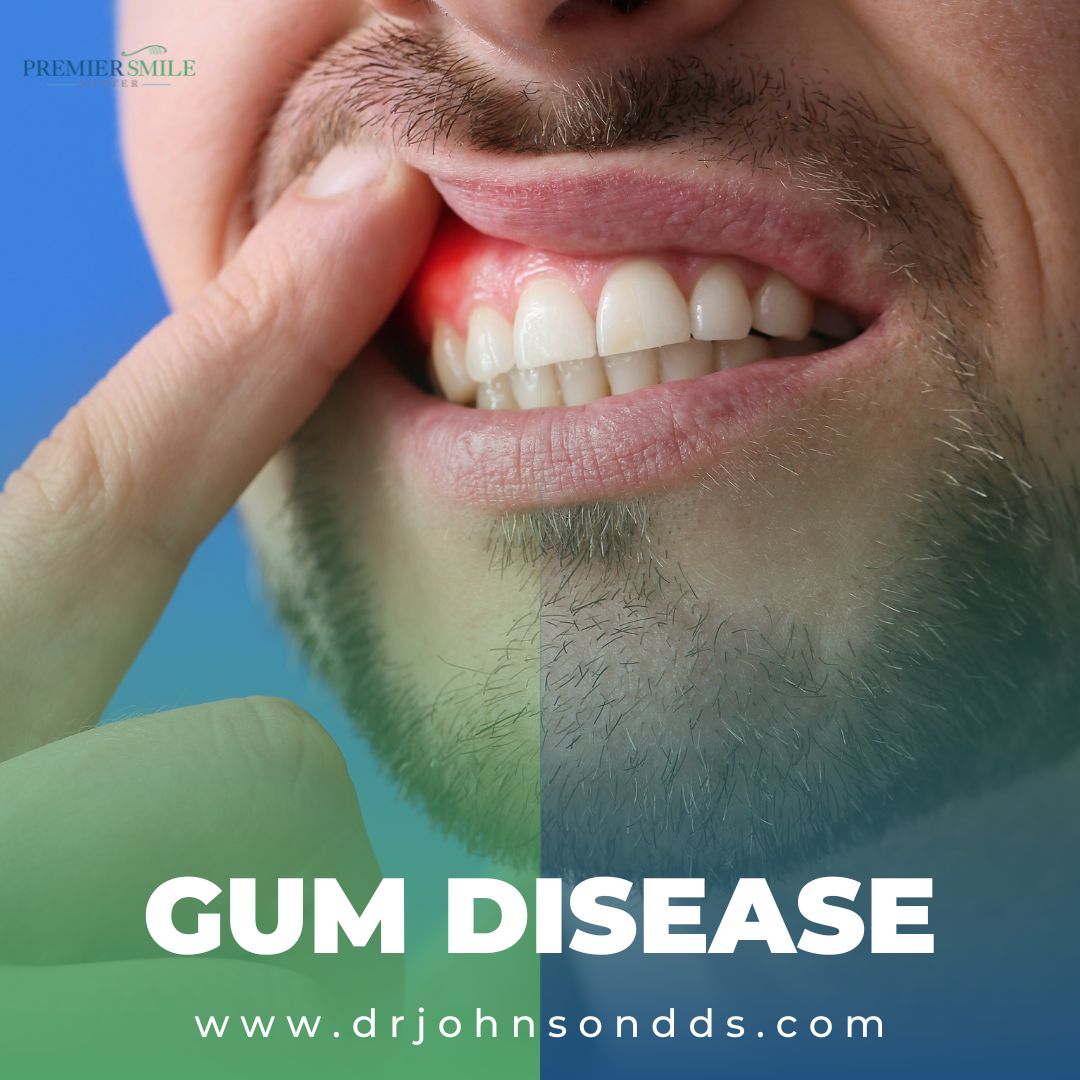 premiersmilectr's tweet photo. Gum disease can affect more than just your smile—it impacts your overall health. But don’t worry, laser gum treatment is here to help! This minimally invasive procedure effectively treats gum disease without the discomfort of traditional methods.

💻https://t.co/D1Xs2uqPjh https://t.co/FnqzamINBg