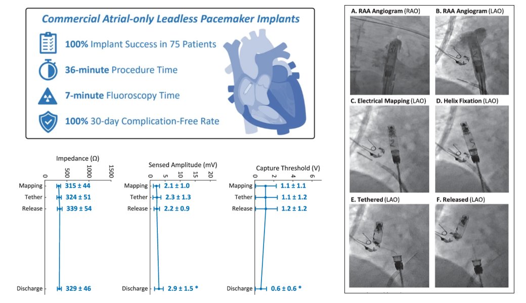 JICE (@jice_ep) on Twitter photo 🚨Latest #OpenAccess Article in
<a href="/JICE_EP/">JICE</a>
Atrial Helix-fixation Leadless Pacemaker: Real-World Single-Chamber Implant Experience
🧐📖 doi.org/10.1007/s10840…
by <a href="/Drdevignair/">Dr. Devi G Nair</a>, Ken W. Lee, Nima Badie, <a href="/leonard_ganz/">Leonard Ganz</a>, Kyungmoo Ryu & <a href="/CyrusHadadiMD/">Cyrus Hadadi, MD</a>
#EPeeps 🚨Latest #OpenAccess Article in
<a href="/JICE_EP/">JICE</a>
Atrial Helix-fixation Leadless Pacemaker: Real-World Single-Chamber Implant Experience
🧐📖 doi.org/10.1007/s10840…
by <a href="/Drdevignair/">Dr. Devi G Nair</a>, Ken W. Lee, Nima Badie, <a href="/leonard_ganz/">Leonard Ganz</a>, Kyungmoo Ryu & <a href="/CyrusHadadiMD/">Cyrus Hadadi, MD</a>
#EPeeps