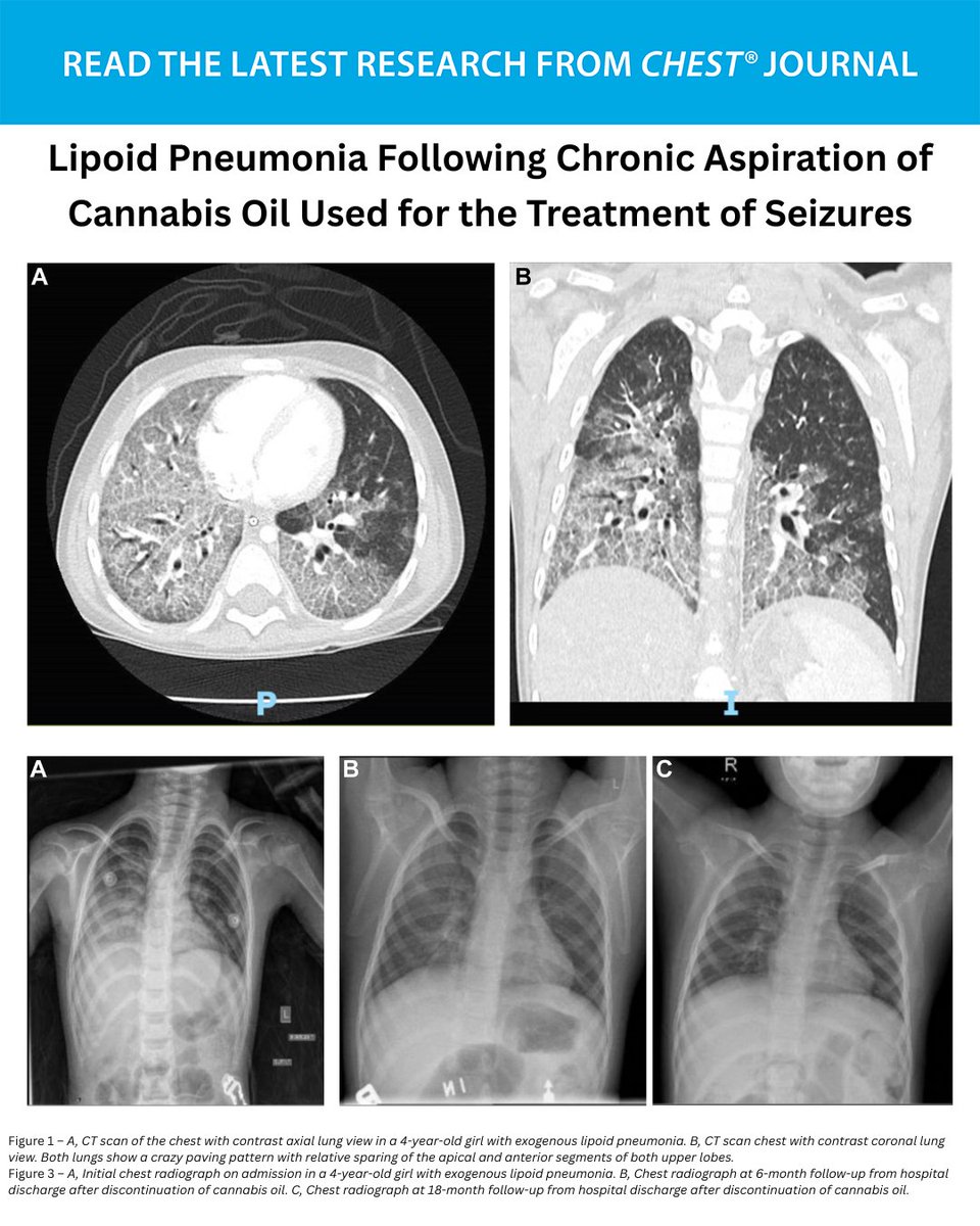 CHEST (@accpchest) on Twitter photo Lipoid #Pneumonia Following Chronic Aspiration of Cannabis Oil Used for the Treatment of #Seizures
What is the diagnosis? Read the full #CHESTPearl in the May issue to learn more: hubs.la/Q03p8CZ-0
#MedEd #MedTwitter #PedsICU Lipoid #Pneumonia Following Chronic Aspiration of Cannabis Oil Used for the Treatment of #Seizures
What is the diagnosis? Read the full #CHESTPearl in the May issue to learn more: hubs.la/Q03p8CZ-0
#MedEd #MedTwitter #PedsICU