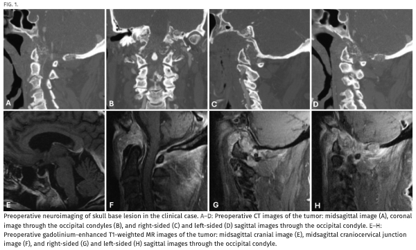 #JNSCaseLessons. Authors discuss staged approach to management of rare isolated clival and bilateral occipital condyle metastasis from urothelial carcinoma. thejns.org/caselessons/vi…