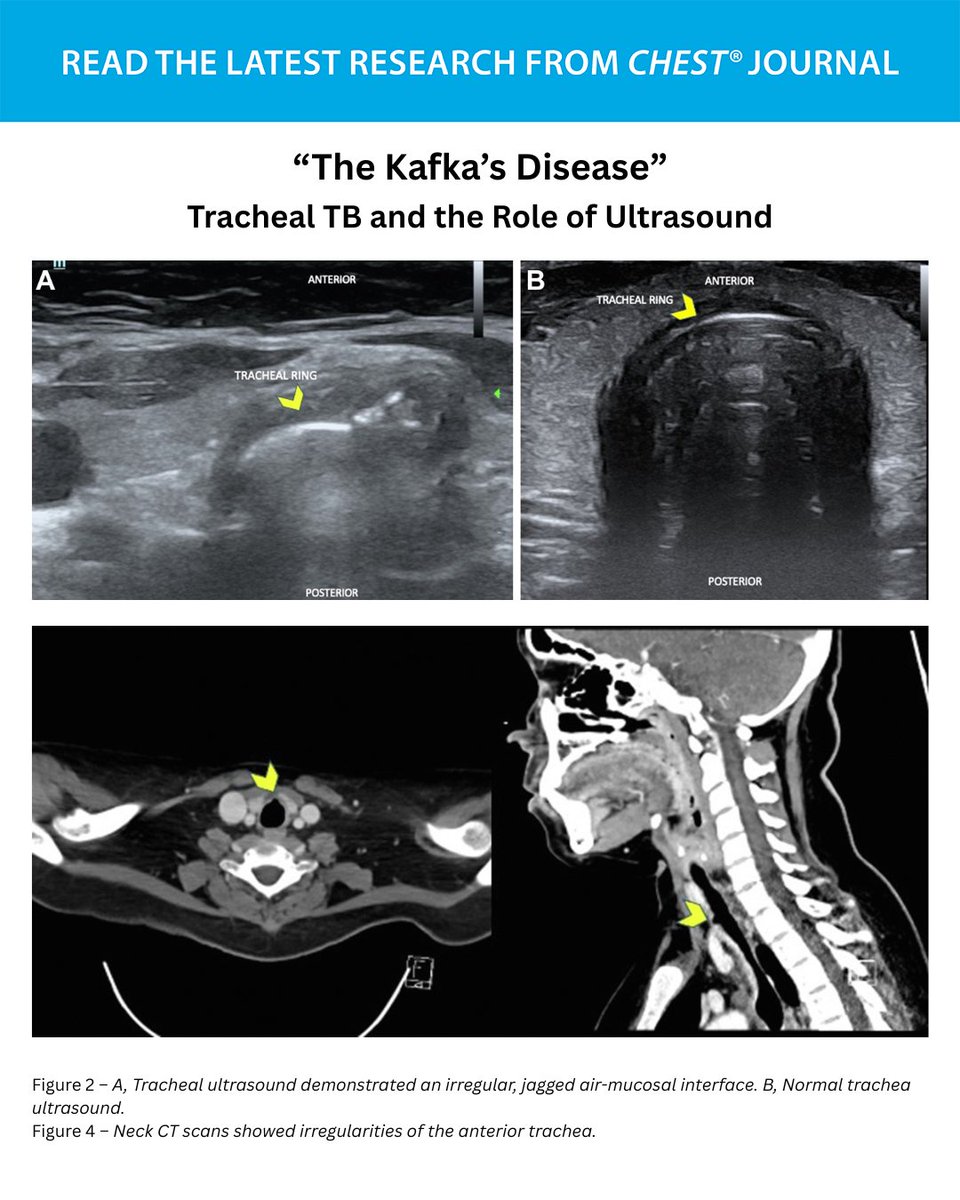 CHEST (@accpchest) on Twitter photo Ultrasound Corner: “The Kafka's Disease” – Tracheal #TB and the Role of Ultrasound
What's the most likely diagnosis? Read the full research in the May issue to learn more: hubs.la/Q03p8MyL0
#MedEd #MedTwitter Ultrasound Corner: “The Kafka's Disease” – Tracheal #TB and the Role of Ultrasound
What's the most likely diagnosis? Read the full research in the May issue to learn more: hubs.la/Q03p8MyL0
#MedEd #MedTwitter