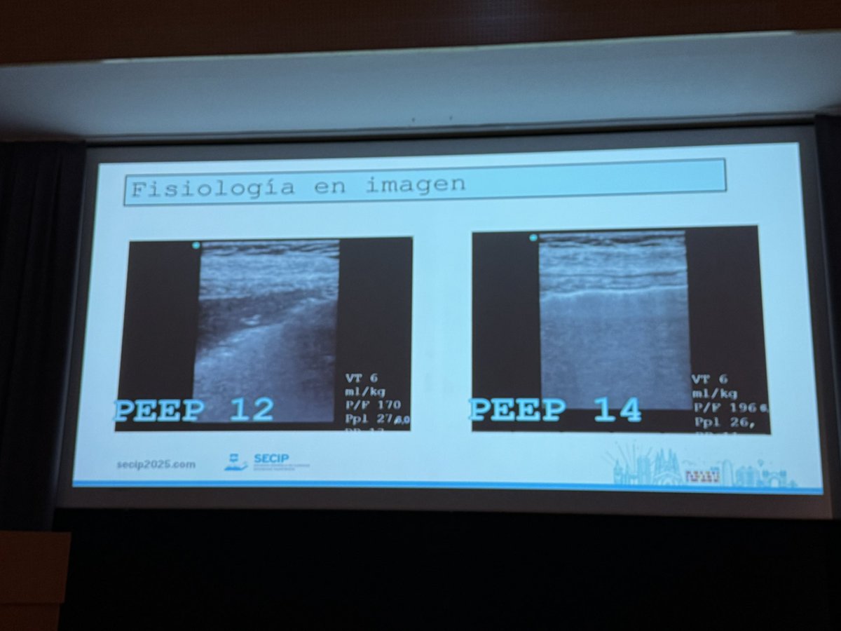 GRSECIP's tweet photo. La ecografía pulmonar anterior con un LUSI >50% predice con buena precisión (AUC 0,86) la mejoría en el intercambio gaseoso tras el prono en pacientes con SDRA. #SECIP2025 @lasecip @ https://t.co/8FruCQ4jiQ