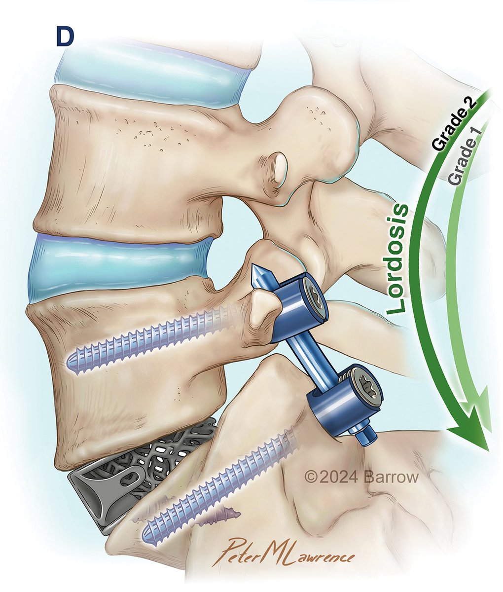 Peter M. Lawrence (@petermlawrence1) on Twitter photo New work published in <a href="/WorldNeurosurg/">World Neurosurgery Journal</a> for the article “Predicting Immediate Lordosis
Restoration After Anterior Lumbar Interbody Fusion and the Effect of Posterior Column Osteotomies” written by <a href="/BarrowNeuro/">BarrowNeurological</a> Drs. Harrison Farber, Juan Uribe, Jay D. Turner, et al.
#neurosurgery New work published in <a href="/WorldNeurosurg/">World Neurosurgery Journal</a> for the article “Predicting Immediate Lordosis
Restoration After Anterior Lumbar Interbody Fusion and the Effect of Posterior Column Osteotomies” written by <a href="/BarrowNeuro/">BarrowNeurological</a> Drs. Harrison Farber, Juan Uribe, Jay D. Turner, et al.
#neurosurgery