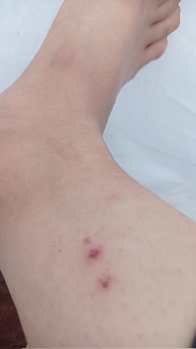 Heba_wael2's tweet photo. This is how my hands and feet look because of the lack of hygiene, the tents being close together, and the spread of insects. I am very tired, please help me😭🍉💔
https://t.co/nmnOKVLD7R https://t.co/wrHn4Jd7bg
