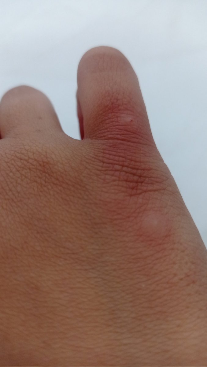 Heba_wael2's tweet photo. This is how my hands and feet look because of the lack of hygiene, the tents being close together, and the spread of insects. I am very tired, please help me😭🍉💔
https://t.co/nmnOKVLD7R https://t.co/wrHn4Jd7bg
