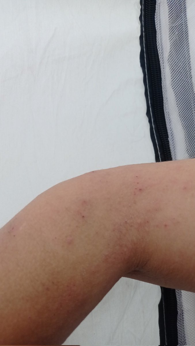 Heba_wael2's tweet photo. This is how my hands and feet look because of the lack of hygiene, the tents being close together, and the spread of insects. I am very tired, please help me😭🍉💔
https://t.co/nmnOKVLD7R https://t.co/wrHn4Jd7bg