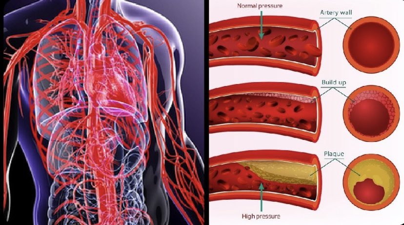 Yüksek Tansiyon

Yetişkinlerin %50'sinde görülür.
Büyük ilaç şirketleri bundan iyi kazanç sağlıyor.

Ama gerçek şu ki:
Yüksek tansiyonun kökeninde yatan çoğunlukla stres ve yanlış yaşam şeklidir.

İşte nasıl düzeltileceği:
