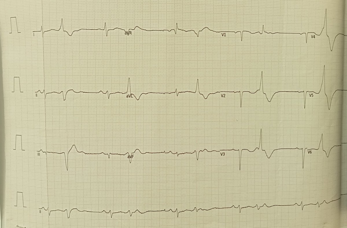 53-year-old woman undergoing PVC ablation, in Flecainide 200 mg therapy.
She arrives at the ER because during the night her husband reported that the patient had wheezing, shaking movements, loss of consciousness