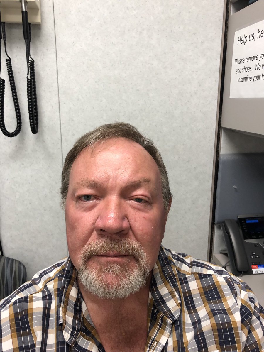Janetbirdope's tweet photo. #ClinicalPearl
Residual@Bell’s #palsy
#ptosis #enopthalmos
What would you@look for if acute?
#ClinicalPearl https://t.co/sa3nQlJbcE