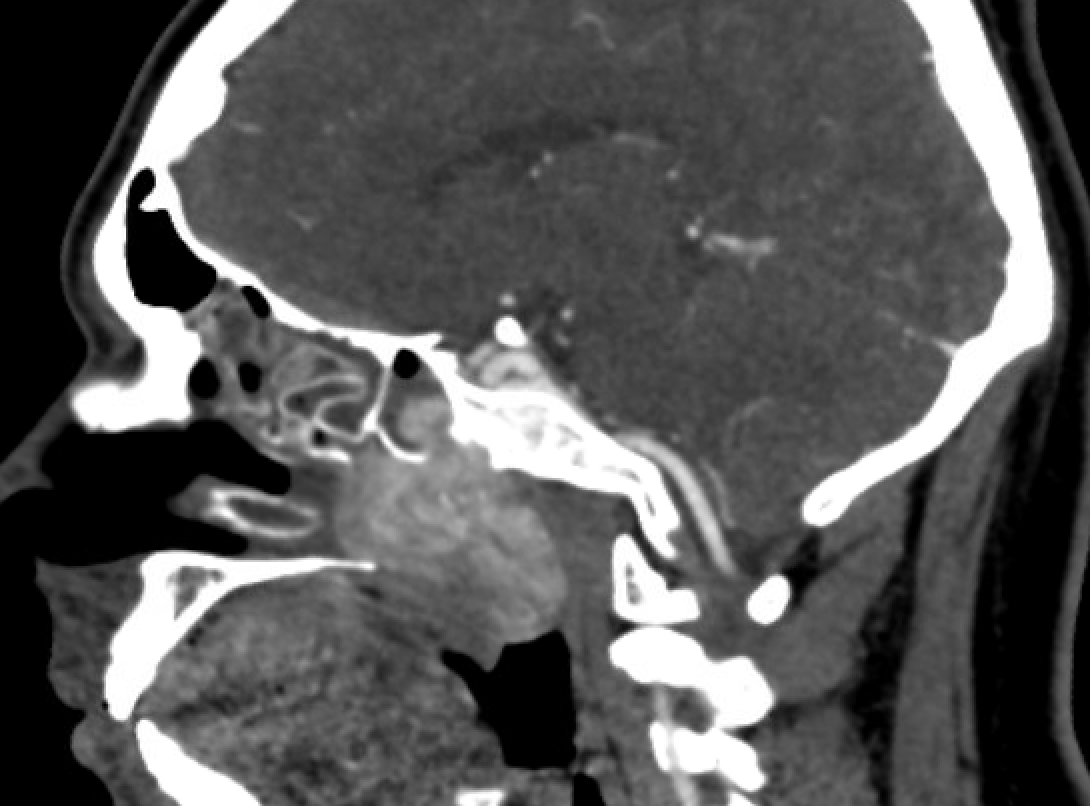 AsmaroMD's tweet photo. Memorable Memorial Day.. teenage boy transfer from OSH w/ JNA skull base tumor to kick off the new chapter w/ Dr. Eric Succar. Home POD#2 #neurosurgery #IndependentPractice #ComprehensiveCare