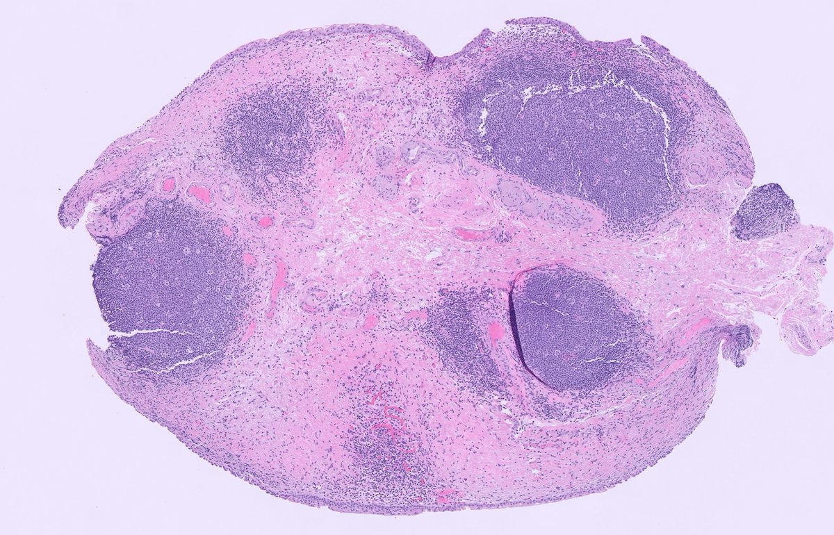 slusagar's tweet photo. 70 y/o with dysuria, cystoscopy shows red patches

▶️#beautyinb9 #GUpath follicular cystitis

top DDx is follicular lymphoma https://t.co/FNwtRxEkdw
