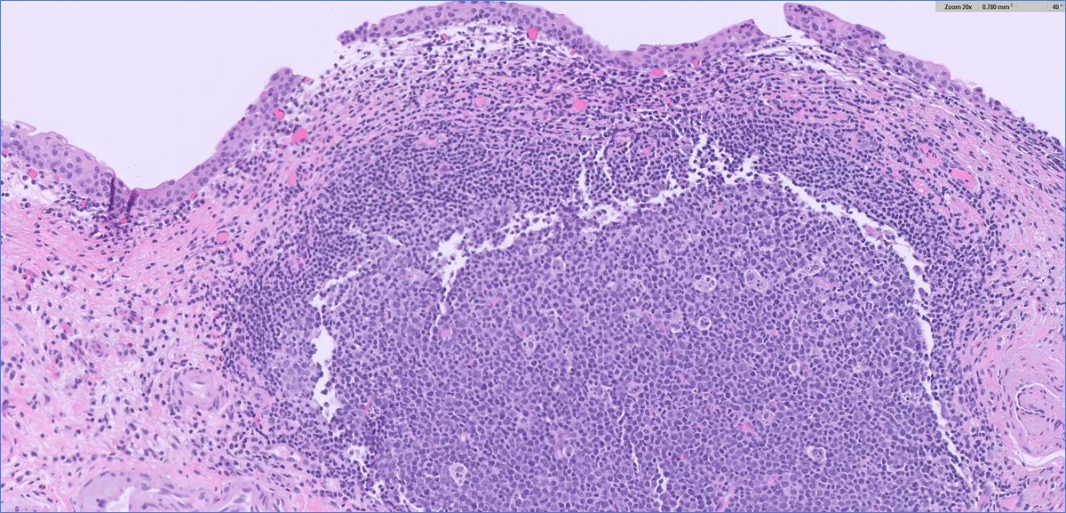 slusagar's tweet photo. 70 y/o with dysuria, cystoscopy shows red patches

▶️#beautyinb9 #GUpath follicular cystitis

top DDx is follicular lymphoma https://t.co/FNwtRxEkdw